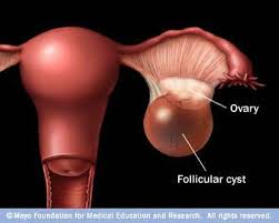 Pin By Katie Jeaneila On Health Ovarian Cyst Ovarian Cyst Causes Follicular Cyst