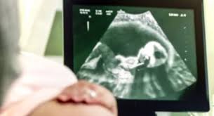 Gambar pada hasil cetakan usg 2d memberikan bayangan bentuk janin dan area cara baca hasil usg juga bisa dengan memerhatikan ukuran gambar. Viral Hasil Usg Ungkap Hal Mengerikan Awalnya Sudah Yakin Hamil 9 Bulan