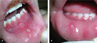 Examples of particular herpes research include drug development, vaccines and genome editing. Nongenital Herpes Simplex Virus American Family Physician