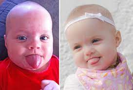 Baby With Tongue Sticking Out Finally Diagnosed After Mother Googles Symptoms Metro News