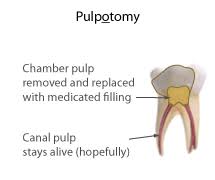 The use of pulpotec after a pulpotomy performed with laser is also recommended. Pulpotomy Wikipedia