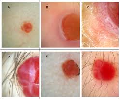 Image result for Pyogenic Granuloma
