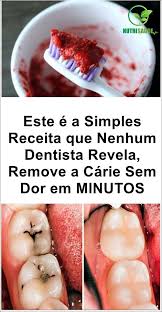 Como Eliminar As Caries Em 15 Minutos Passo A Passo Carie Dentaria Carie Caries