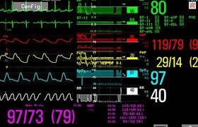 Icu menyediakan tindakan medis yang bersifat kritis dan sistem pendukung fungsi organ tubuh (life. Perawatan Intensif Apa Arti Dari Setiap Bagian Gambar Di Monitor Icu Galena