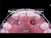 ballista loop activation in orthodontics, impacted canine traction ...