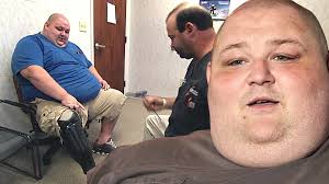 Sobrepeso de James está destruindo a prótese de sua perna direita