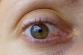 Image result for Eye Pain
