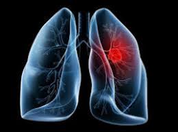 This growth can spread beyond the lung by the process of metastasis into nearby tissue or other parts of the body. Inadequacies In Current Early Stage Lung Cancer Treatment Revealed Ecancer