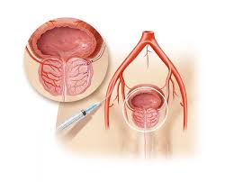 Reviews common tests for these conditions, as well as treatment side effects. Minikugelchen Verkleinern Prostata Gute Besserung