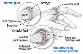 Image result for Rheumatoid Factor