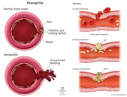 Image result for Bleeding Disorder