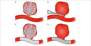 Aneurysm classification and external resources angiography of an aneurism in a cerebral artery aneurysm. Surgical And Endovascular Treatments For Cerebral Aneurysm Download Scientific Diagram