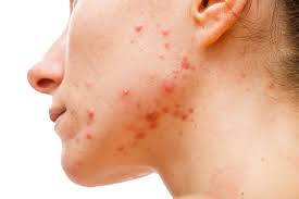 Image result for acne face