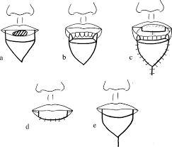 The cosmetic and functional results were evaluated. Combined Tongue Flap And V Y Advancement Flap For Lower Lip Defects British Journal Of Plastic Surgery