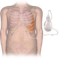 Vacuum bottle, or the pleurx drainage kits. Pleurx Kathetersystem Bd