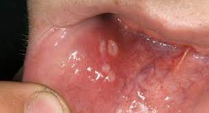 Gingivostomatitis is a combination of gingivitis and stomatitis, or an inflammation of the oral mucosa and gingiva. Gingivostomatitis Babycenter