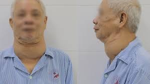 Phẫu thuật cho cụ ông mang khối bướu khổng lồ suốt nhiều năm