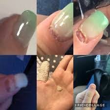A patient attempts to hide a fungal toenail infection under acrylic nails. Why Are My Fingernails Turning Brown After Wearing Acrylic Nails Quora