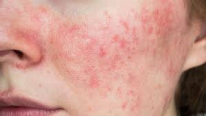 Bagaimana caranya menghilangkan jerawat yang membandel. Roseacea Gejala Kemerahan Mirip Jerawat Di Wajah