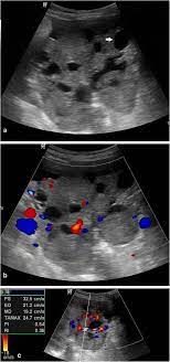 7 color and pulsed doppler ultrasound have also been used in the evaluation of ovarian masses. Sonographic And Doppler Predictors Of Malignancy In Ovarian Lesions Egyptian Journal Of Radiology And Nuclear Medicine Full Text