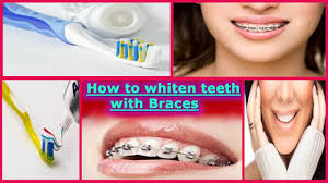 And people who have yellow teeth with braces often the best time to whiten your teeth is before getting braces or after getting them off. How To Whiten Teeth With Braces Diy Teethwalls