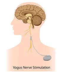 vagus nerve stimulation dramatically reduces inflammation