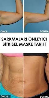 Sarkmalari Onleyici Bitkisel Maske Tarifi Cilt Bakimi Vucut Bakimi Dogal Cilt