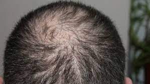 • • • fin not slowing hair loss downfinasteride (self.hairloss). Hair Loss Why Does It Happen And Can It Be Stopped Abc News