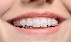 The 1st solution for whitening teeth with braces on. What Are White Braces Birchgrove Dental