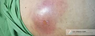 Image result for Skin Abscess