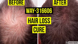 I want my hair back! Cure Hairlosstalk