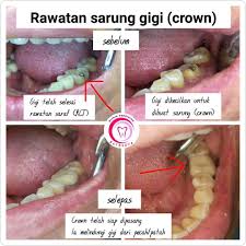 Daftar harga yang kami sediakan bertujuan memudahkan pasien untuk menentukan pilihan perawatan dan konsultasi gigi. Rawatan Sarung Gigi Crown Klinik Pergigian Batrisya Facebook