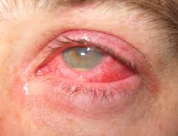 Image result for Ciliary Flush
