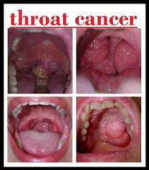 Hpv causes head and neck cancers too. Hpv Virus And Neck Cancer Hpv Infection Head And Neck Cancer