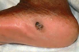 Image result for brown patches on the feet