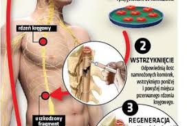 Ze względu na umiejscowienie zaliczamy je do wewnątrzoponowych guzów kanału kręgowego. Cud Dariusz Wstal Z Wozka Inwalidzkiego I Znowu Chodzi Polscy Lekarze Dokonali Niemozliwego Super Express Wiadomosci Polityka Sport