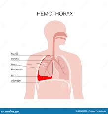 Image result for Hemothorax