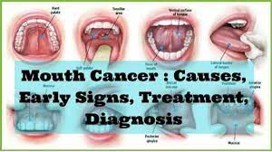 It can appear grayish pink to red and it is ulcerated in nature. Mouth Cancer Causes Early Signs Treatment Diagnosis Jaipur Dental Implants