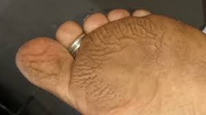 Listerine if you think listerine footbath soak sounds both appalling and oddly intriguing, you're not alone. Amazing Listerine Foot Bath Soak For Dry Cracked Feet Before After
