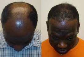 What are another words for hair loss? Abuja Man Exposes How He Re Grow His Hair Naturally Cure Baldness And Severe Hair Loss Within 14 Days Using A Natural Herbal Remedy Vanguard News