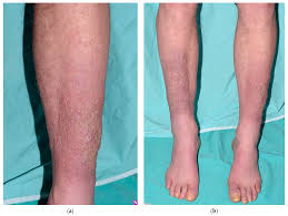 Image result for Pigment stains on the shin