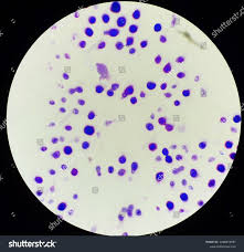 Image result for Cryptococcal Meningitis