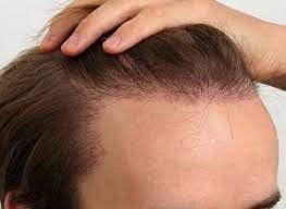As the cleveland clinic explains, you should wash your hands before and after use. Ketoconazole For Hair Loss Efficiently Hair Loss Regrow Hair Stop Hair Loss