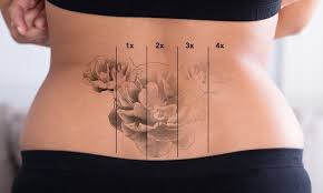 Before Tattoo Removal