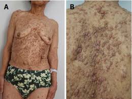 There are three types of neurofibromatosis: Intraductal Papillary Bile Duct Adenocarcinoma And Gastrointestinal Stromal Tumor In A Case Of Neurofibromatosis Type 1
