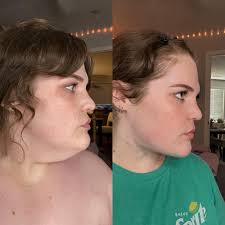 Mini neck lift (platysmaplasty & chin lipo)