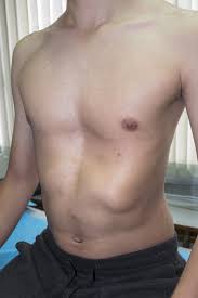 Image result for Pectus Excavatum
