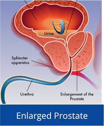 The prostate is a small gland in the male reproductive system. Enlarged Prostate Bph Prostate Cancer Hifu Prostate Services