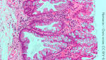  Polyp Risk Rises with Calcium Supplements