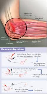 La tendinite du coude est un problème de santé assez fréquent. All Categories Maeva Rupe Osteopathe D O Nice